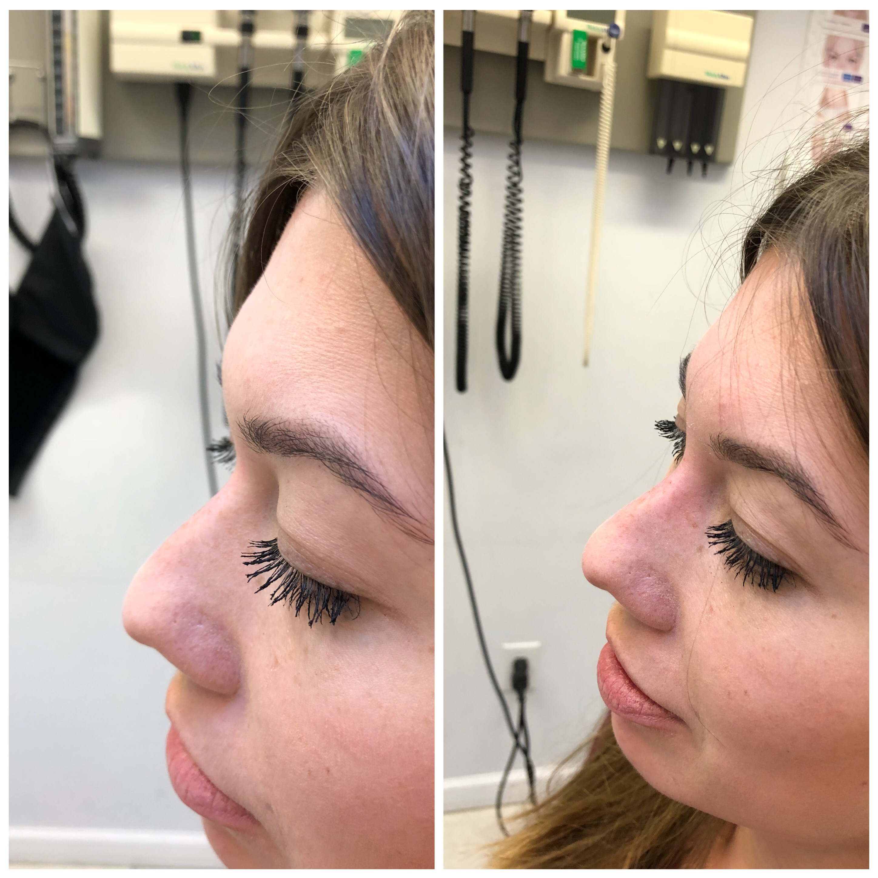 Non-surgical rhinoplasty before and after — profile view showing smoothed bridge