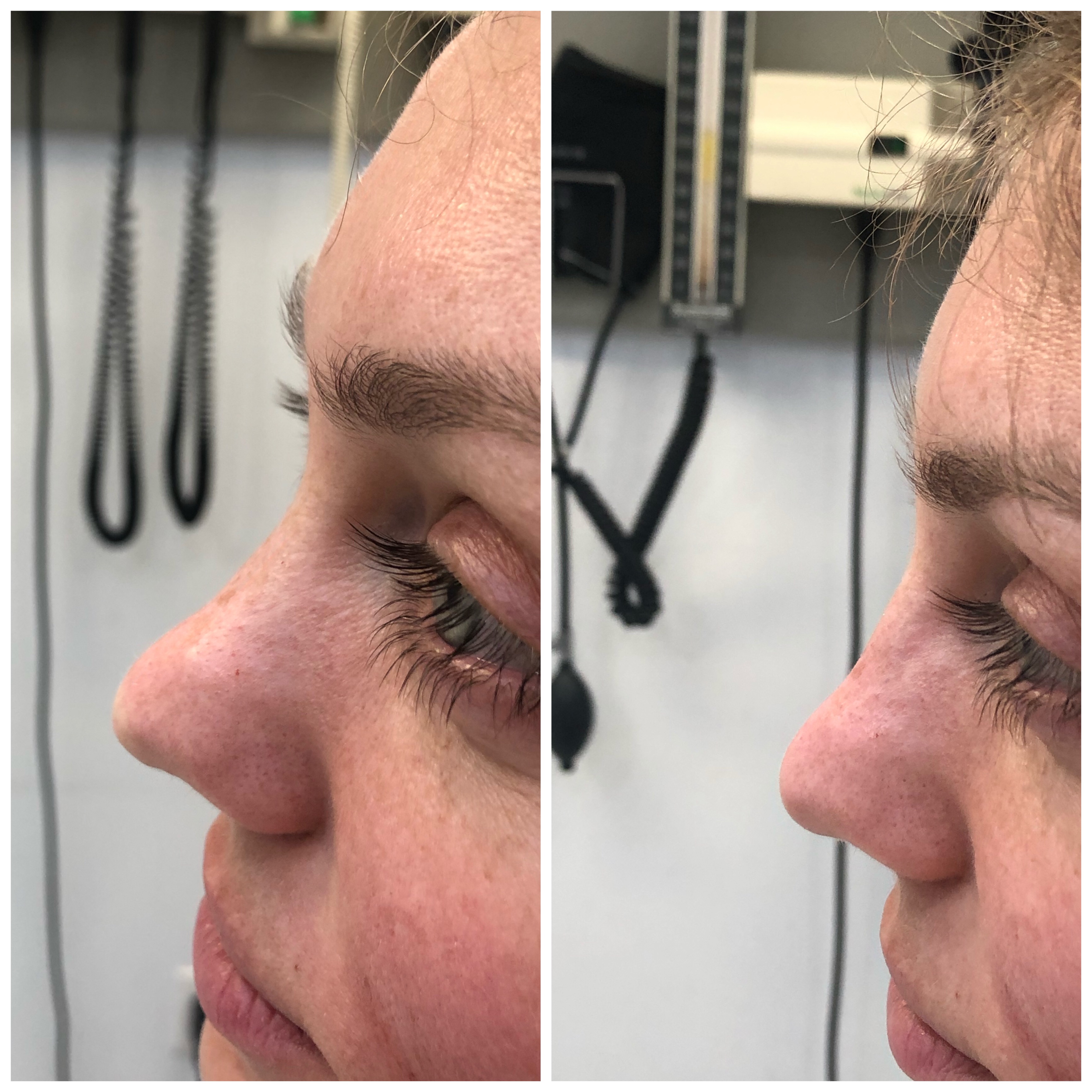 Non-surgical rhinoplasty before and after — profile view showing refined contour