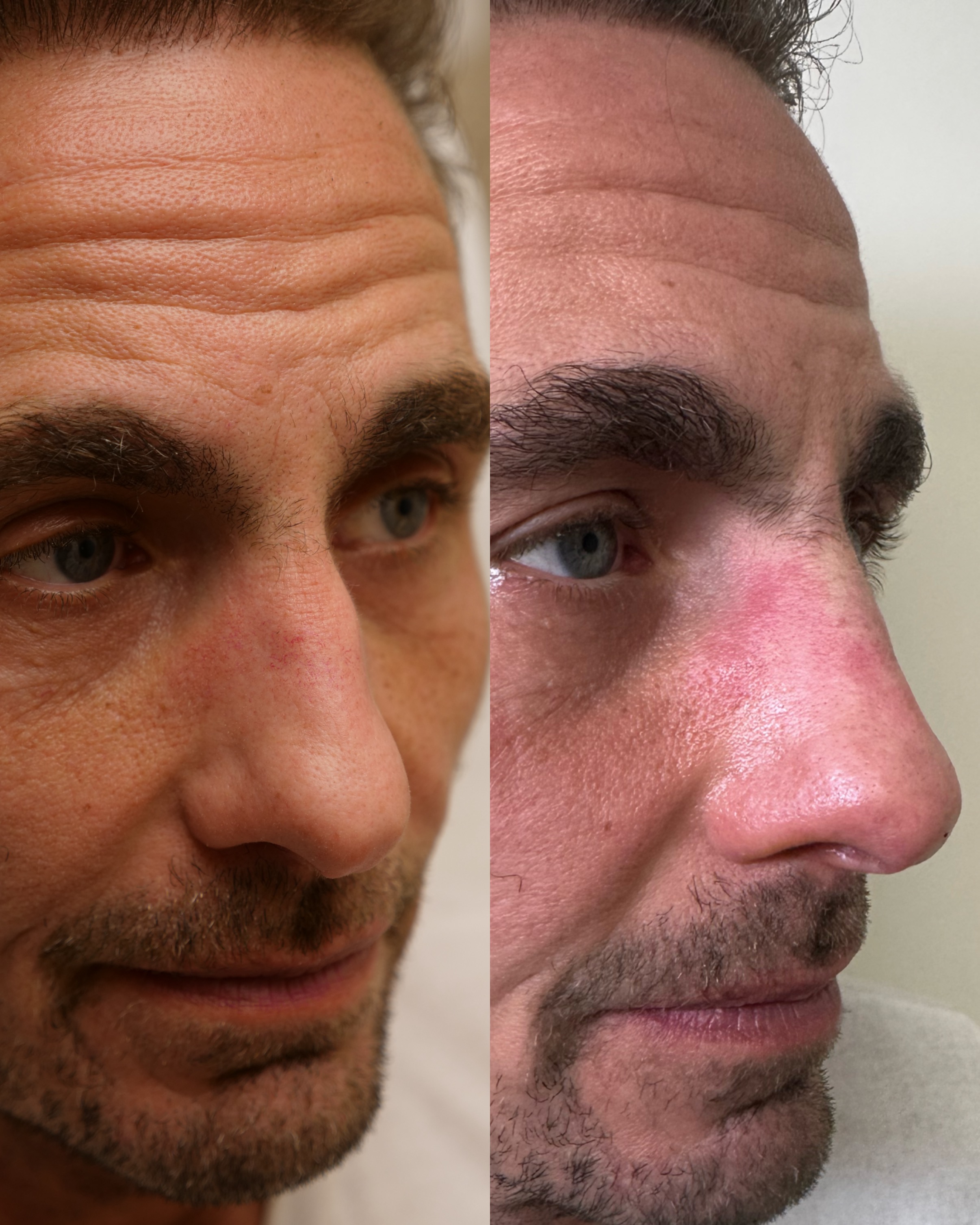 Non-surgical rhinoplasty before and after — front view showing improved symmetry