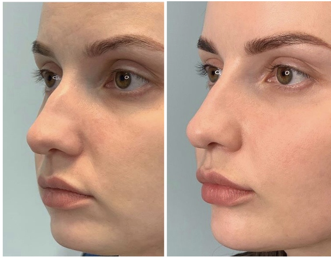 Non-surgical rhinoplasty before and after — Dr. GolBerg patient result